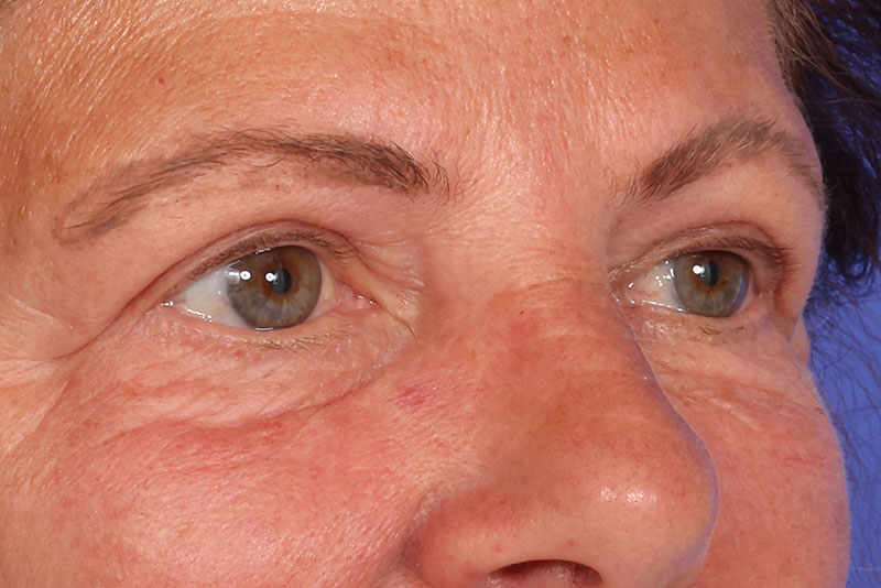 Blepharoplasty Before & After Image