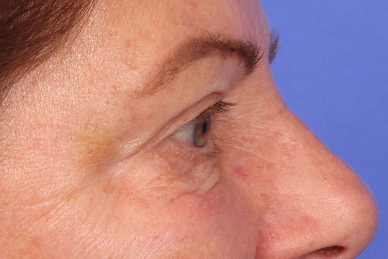 Blepharoplasty Before & After Image