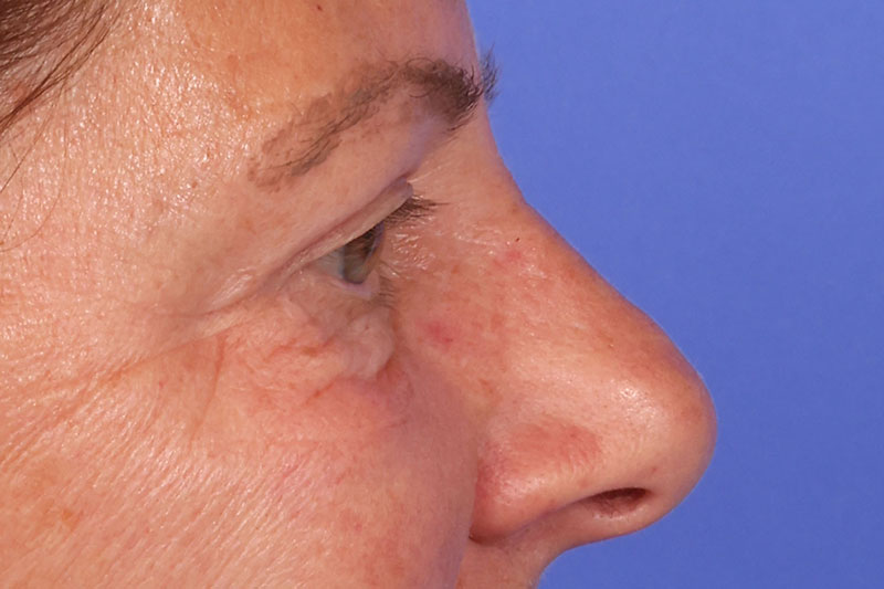 Blepharoplasty Before & After Image