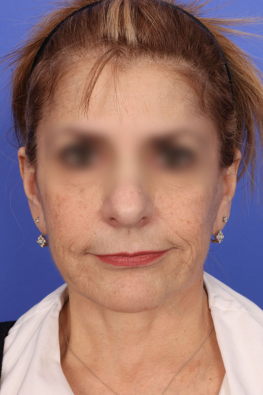 Face Lift Before & After Image