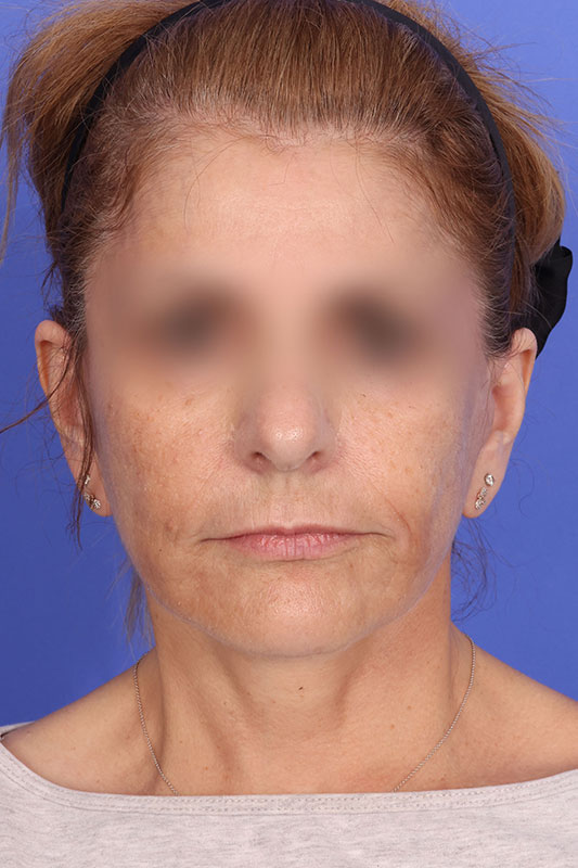 Face Lift Before & After Image