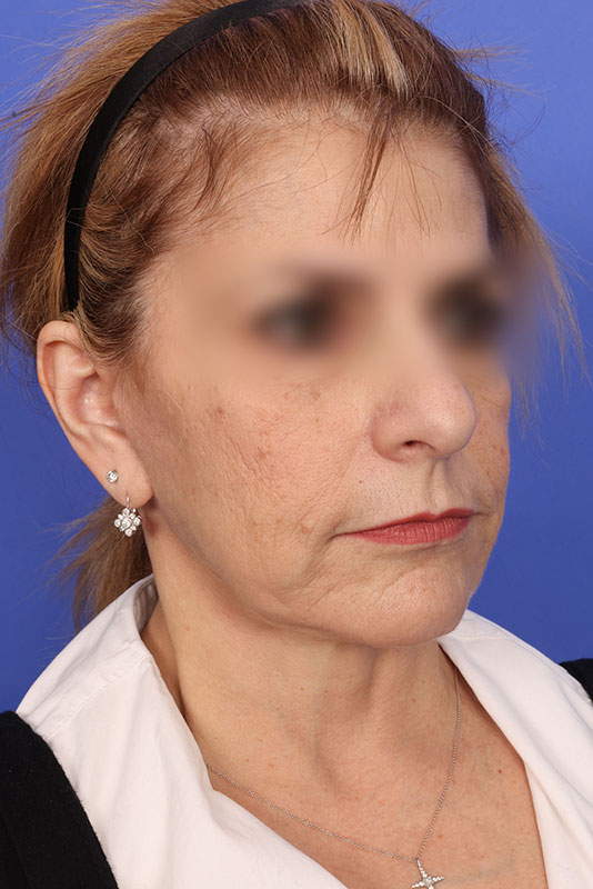 Face Lift Before & After Image