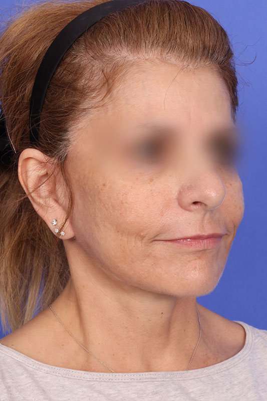 Face Lift Before & After Image