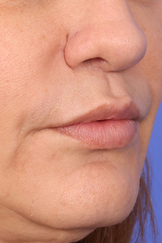 Lip Lift Before & After Image